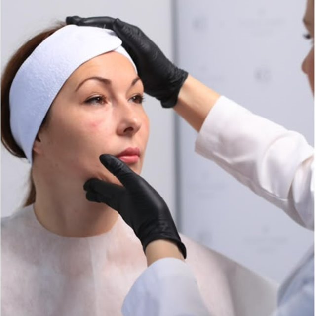 Mid face and jawline assessed before treatment at a Putney clinic in south west London