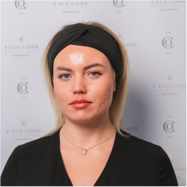 The same client immediately after her skin treatment at a Putney clinic in south west London
