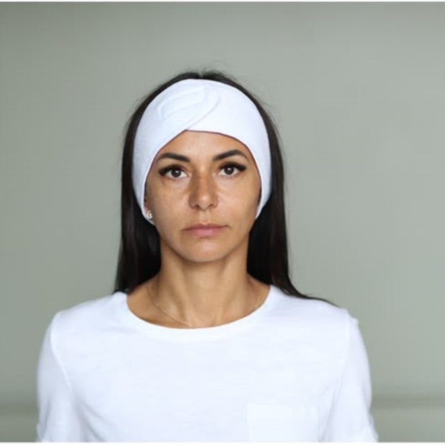 Client photographed before a course of skin treatment at an aesthetic clinic in Putney, London