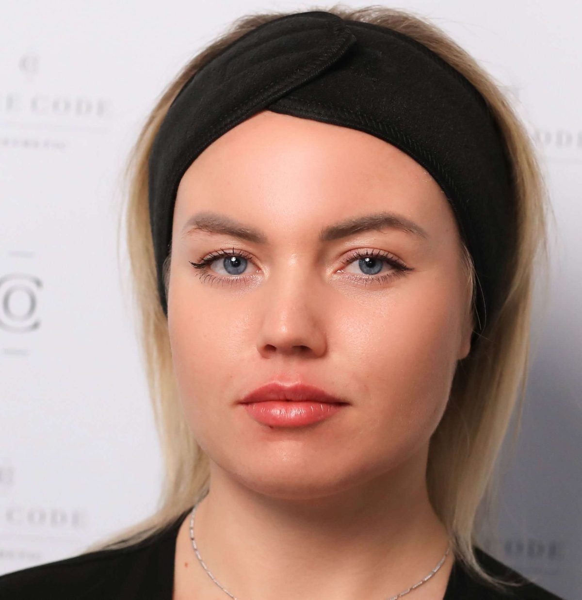 Nasolabial folds after dermal filler treatment at a Putney clinic in London