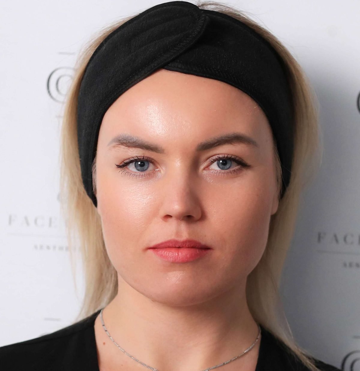 Nasolabial folds before dermal filler treatment at a Putney clinic in London